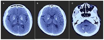 Case Report: Mitochondrial Encephalomyopathy Presents as Epilepsy, Ataxia, and Dystonia With a Rare Mutation in MT-TW